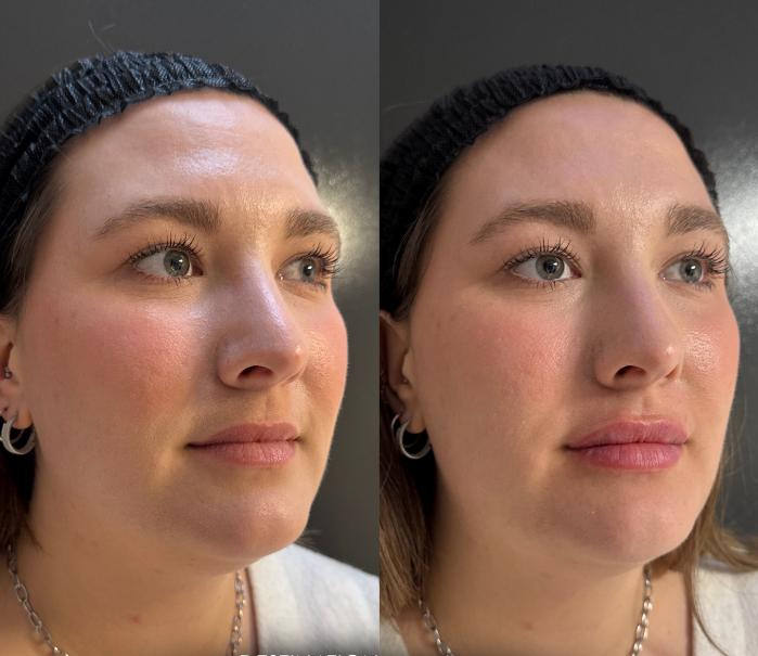 Before & After Dermal Fillers Case 226 Right Side View in Sacramento, CA