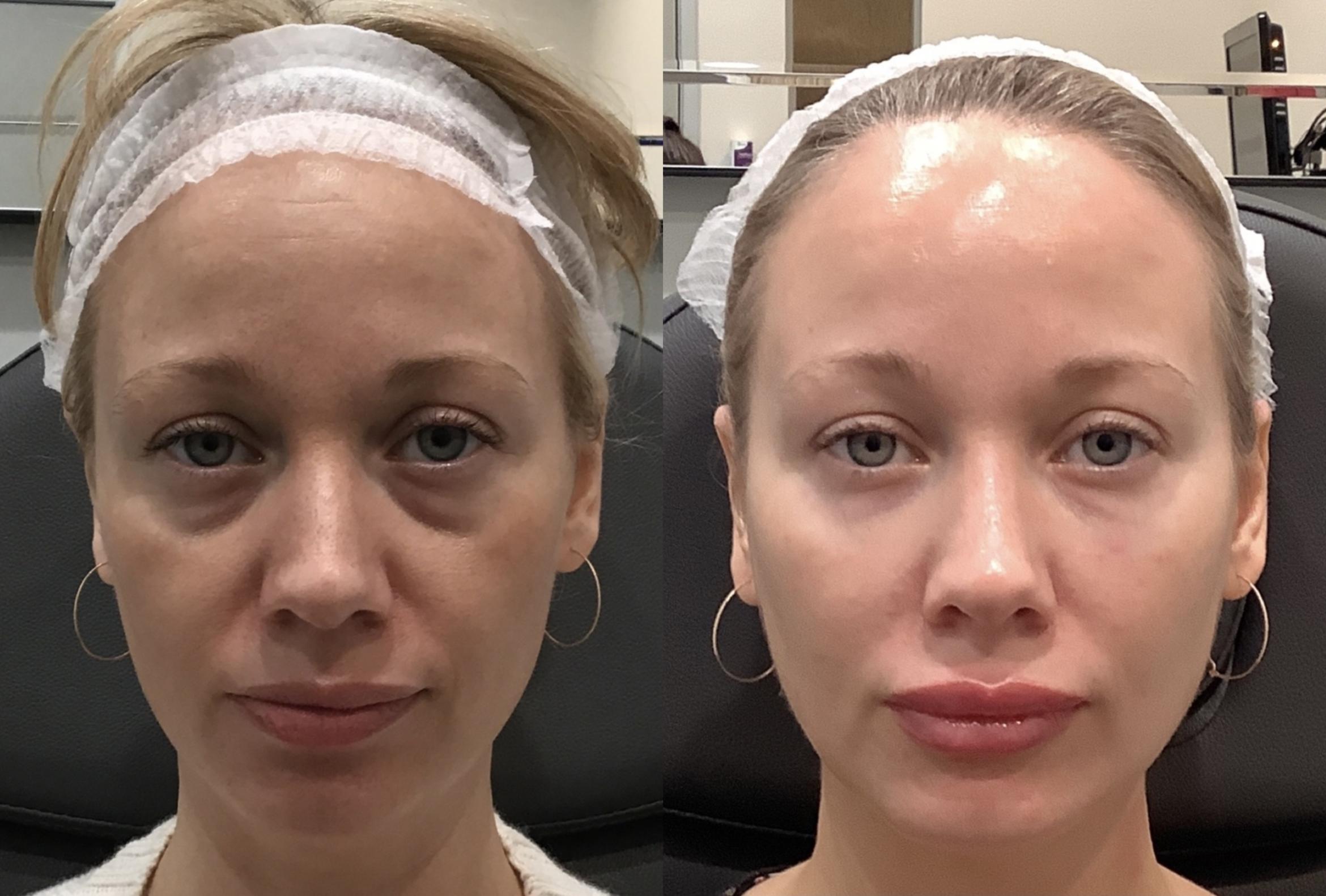 Before & After Dermal Fillers Case 60 Front View in Sacramento, CA