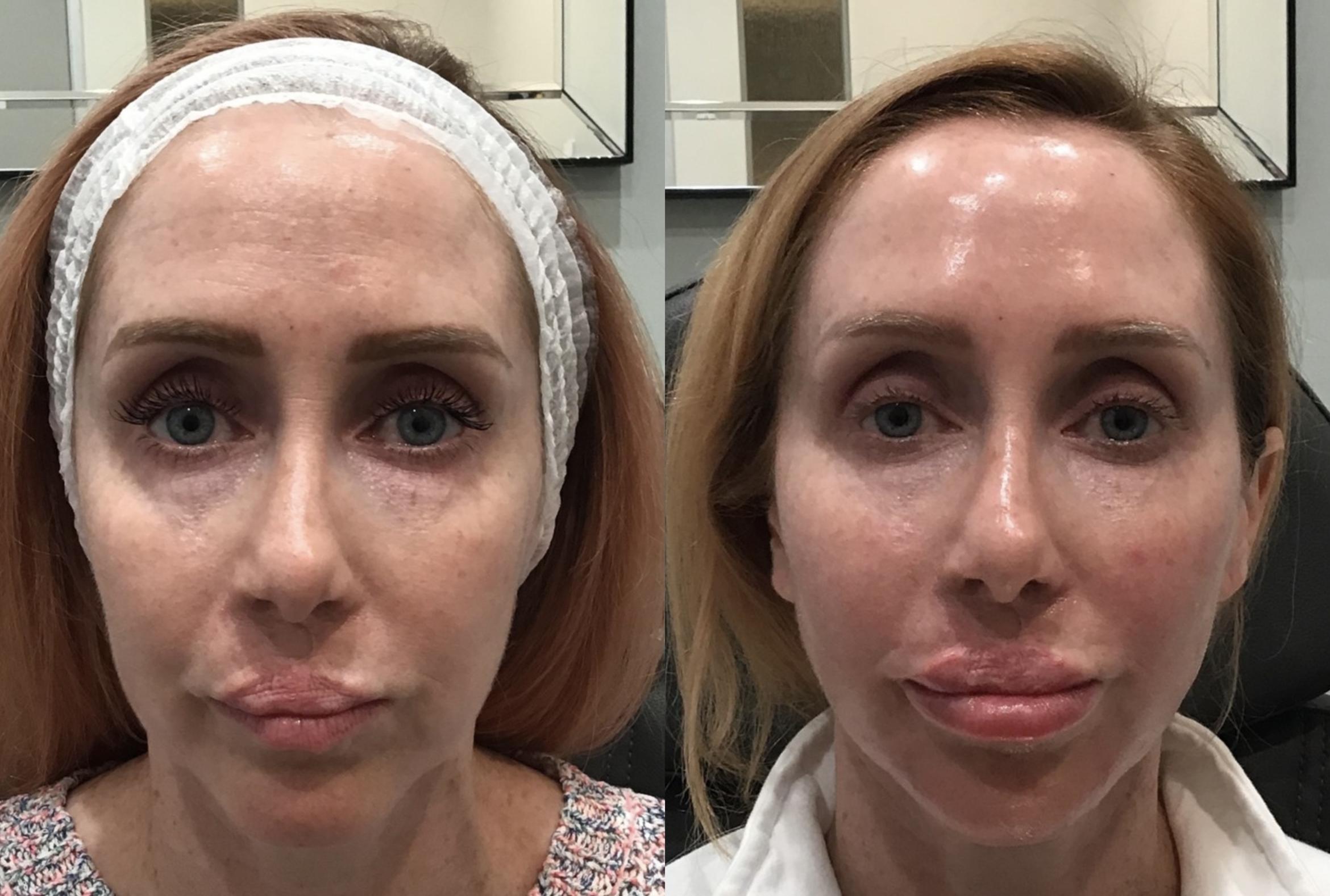 Before & After Dermal Fillers Case 69 Front View in Sacramento, CA