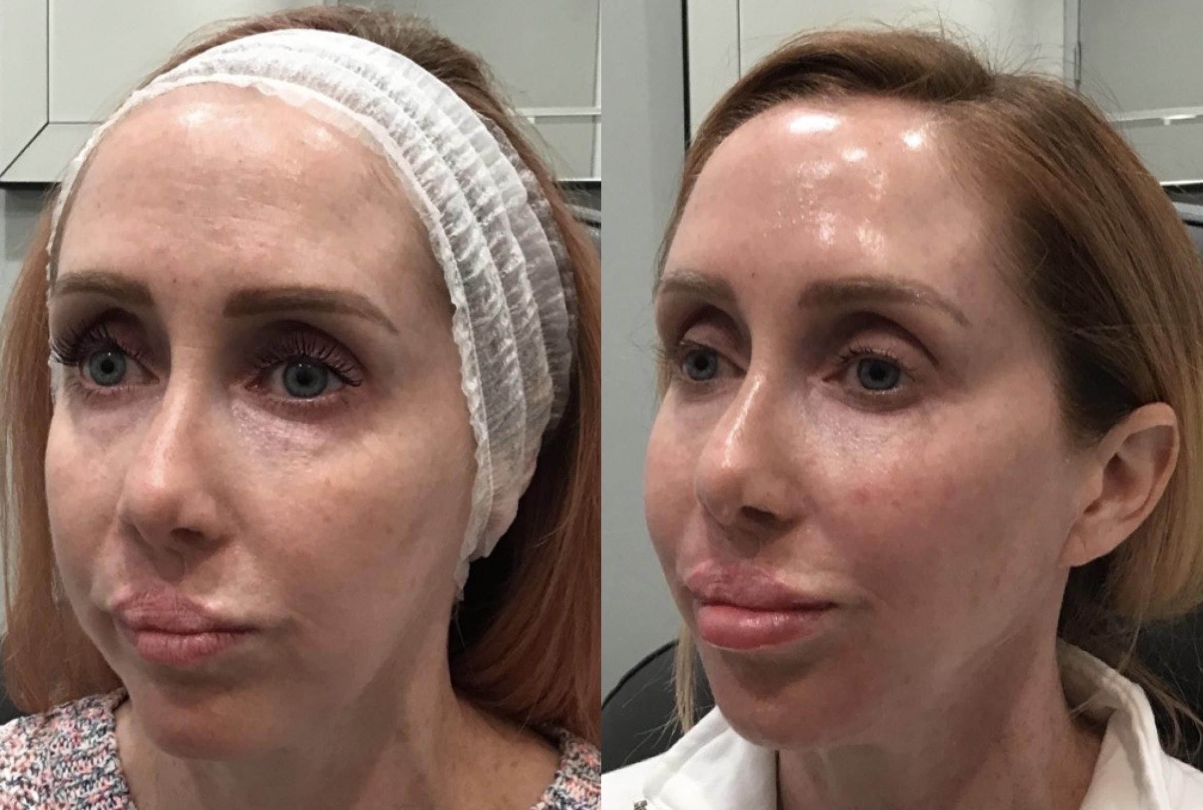 Before & After Dermal Fillers Case 69 Right Side View in Sacramento, CA