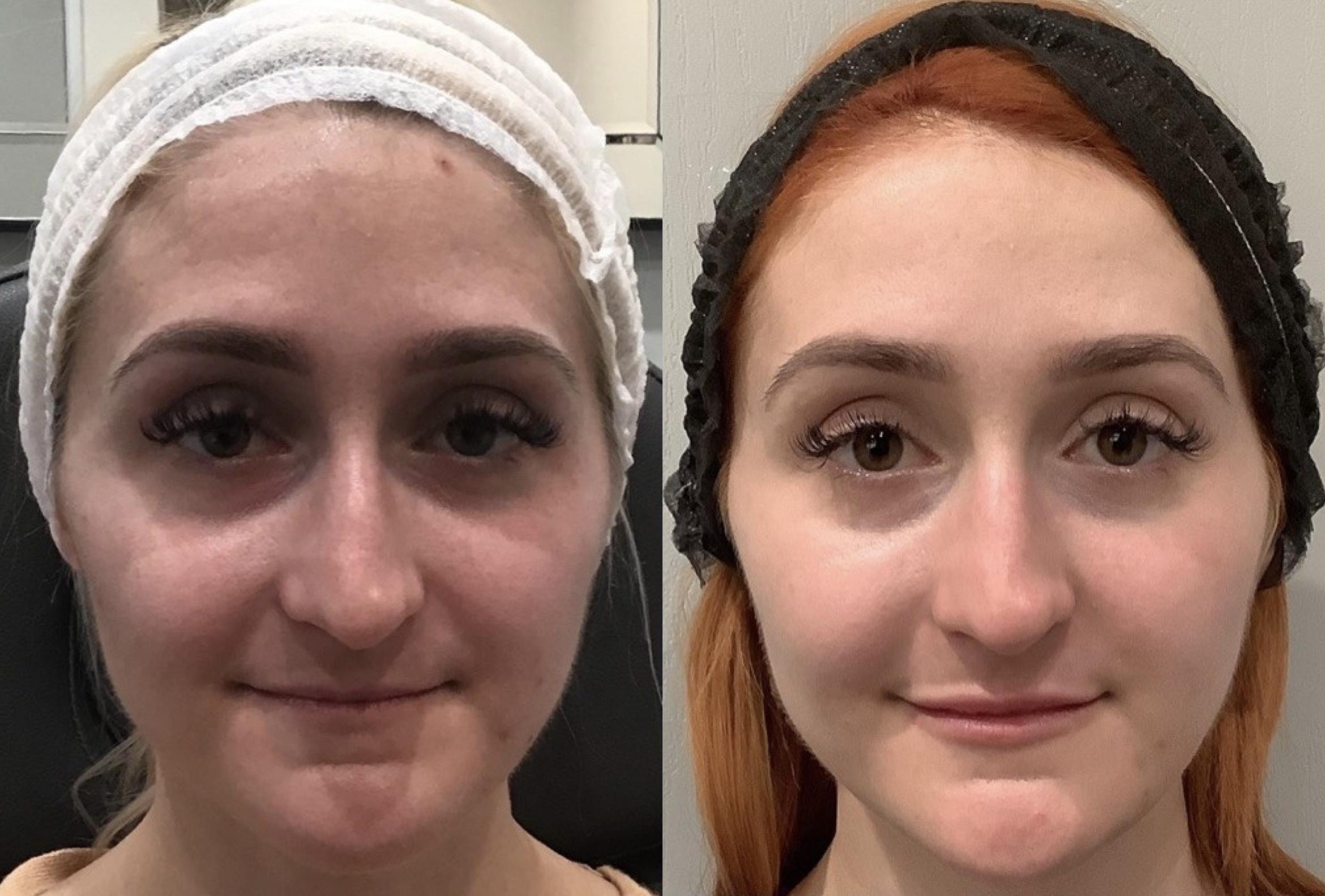Before & After Dermal Fillers Case 71 Front View in Sacramento, CA