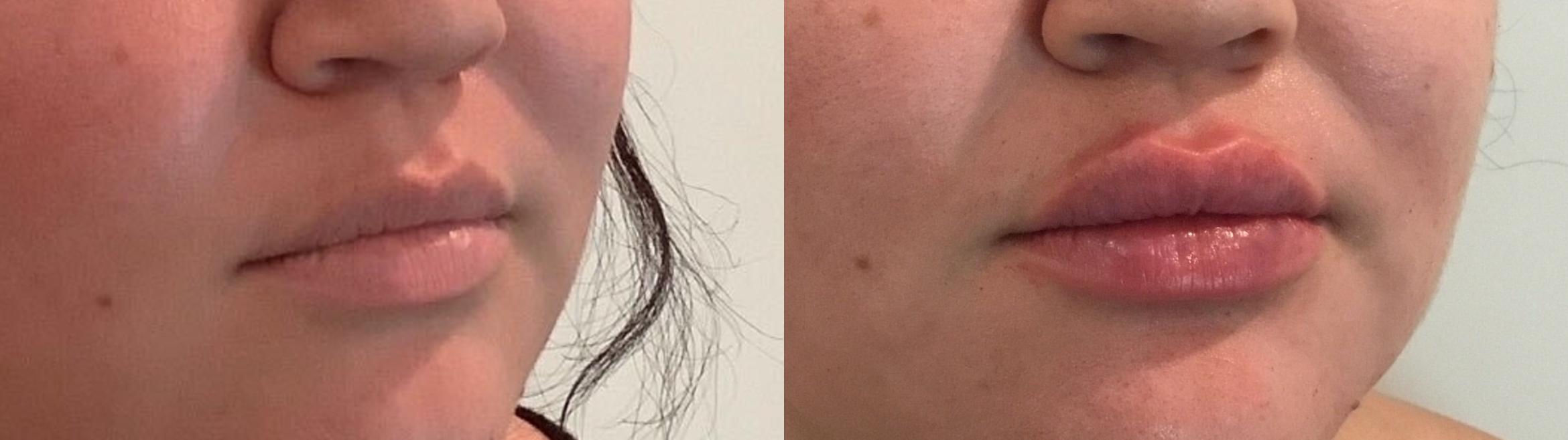 Before & After Dermal Fillers Case 79 Right Side View in Sacramento, CA