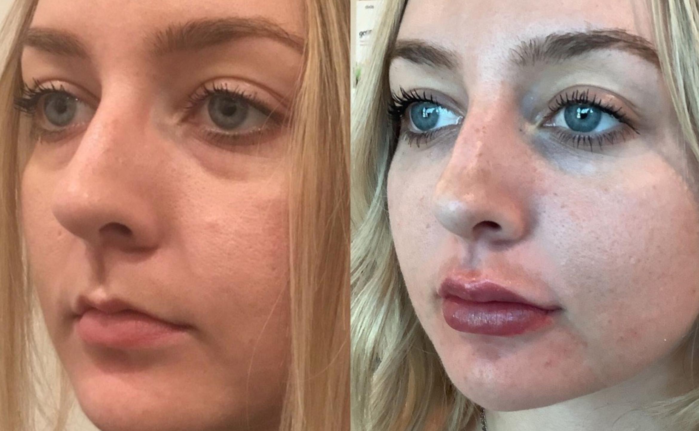 Dermal Fillers Before And After Pictures Case 93 Sacramento Ca