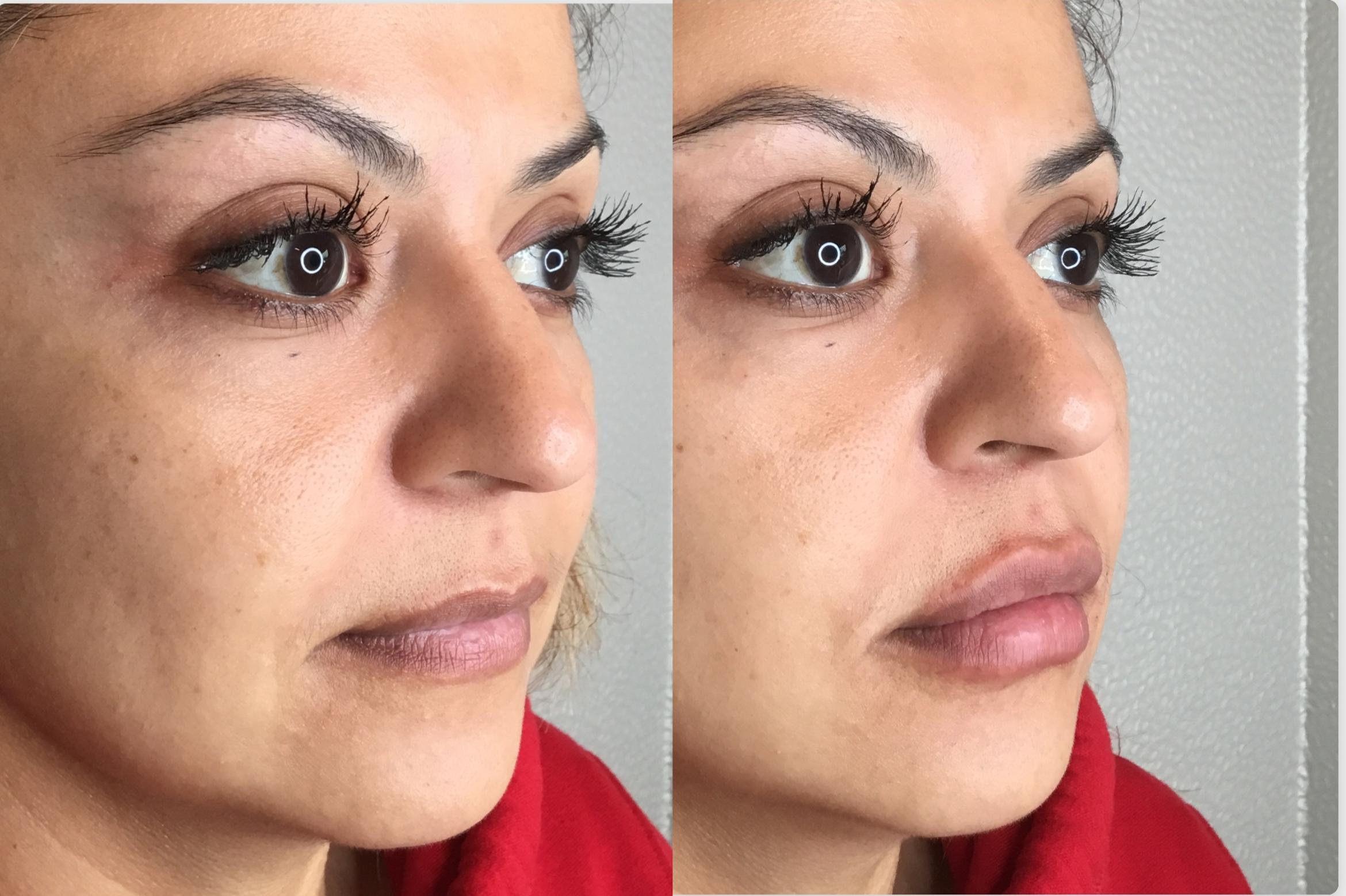 Before & After Dermal Fillers Case 94 Right Side View in Sacramento, CA