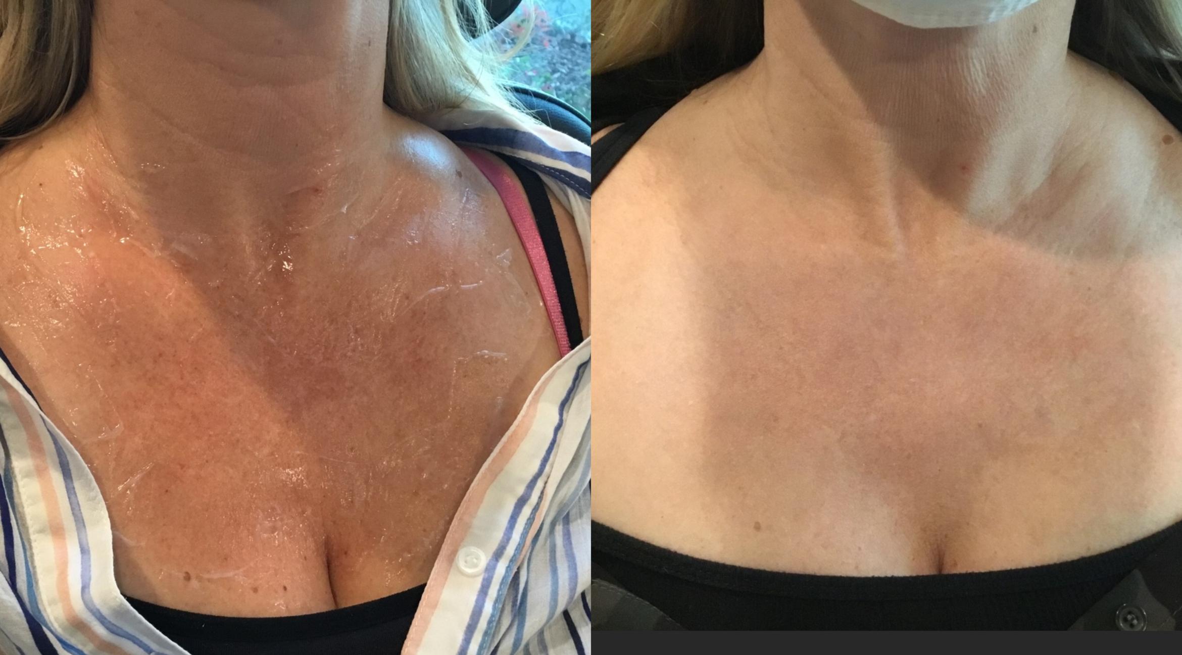Before & After IPL Case 61 Front View in Sacramento, CA