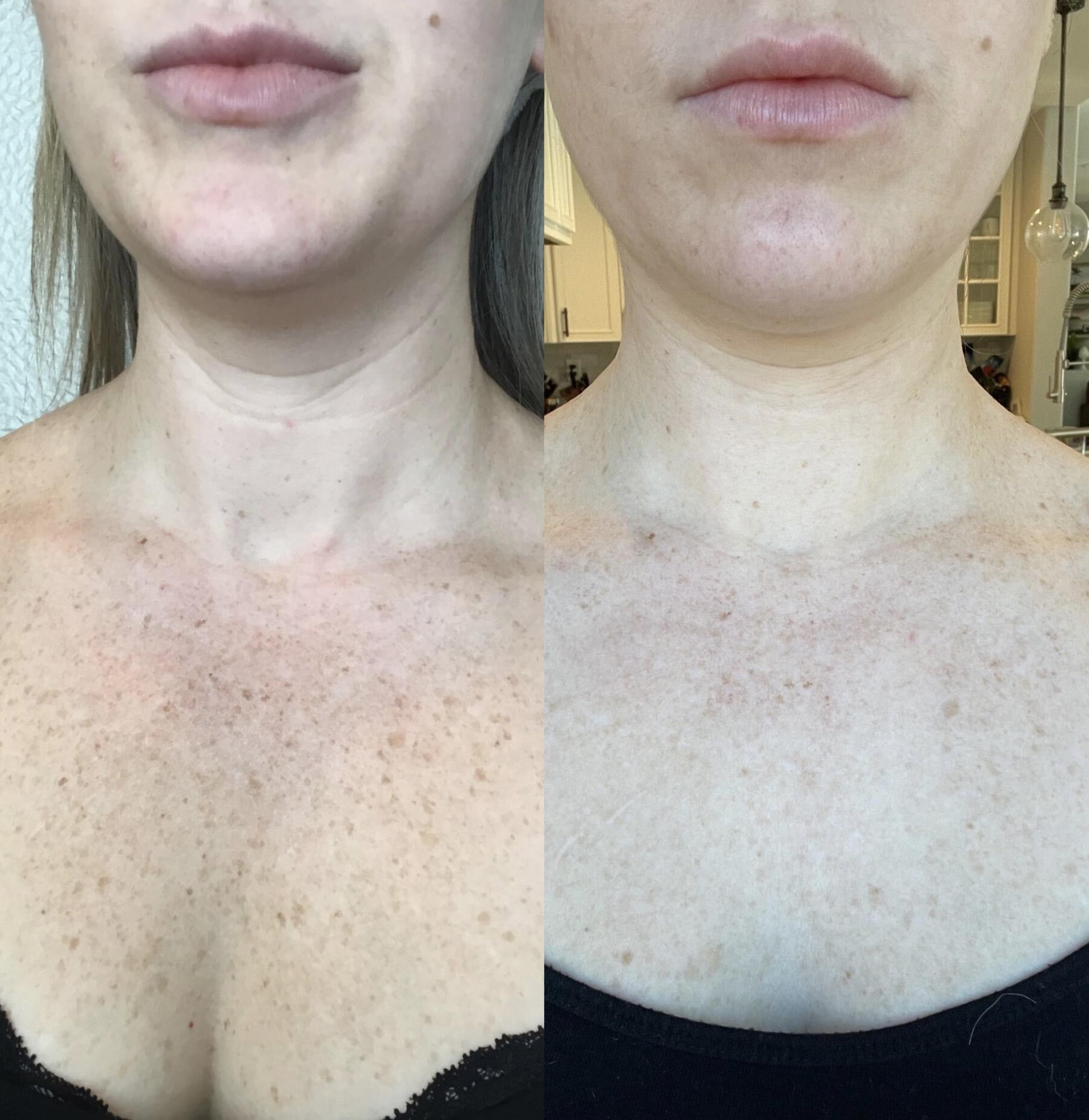 Before & After IPL Case 62 Front View in Sacramento, CA