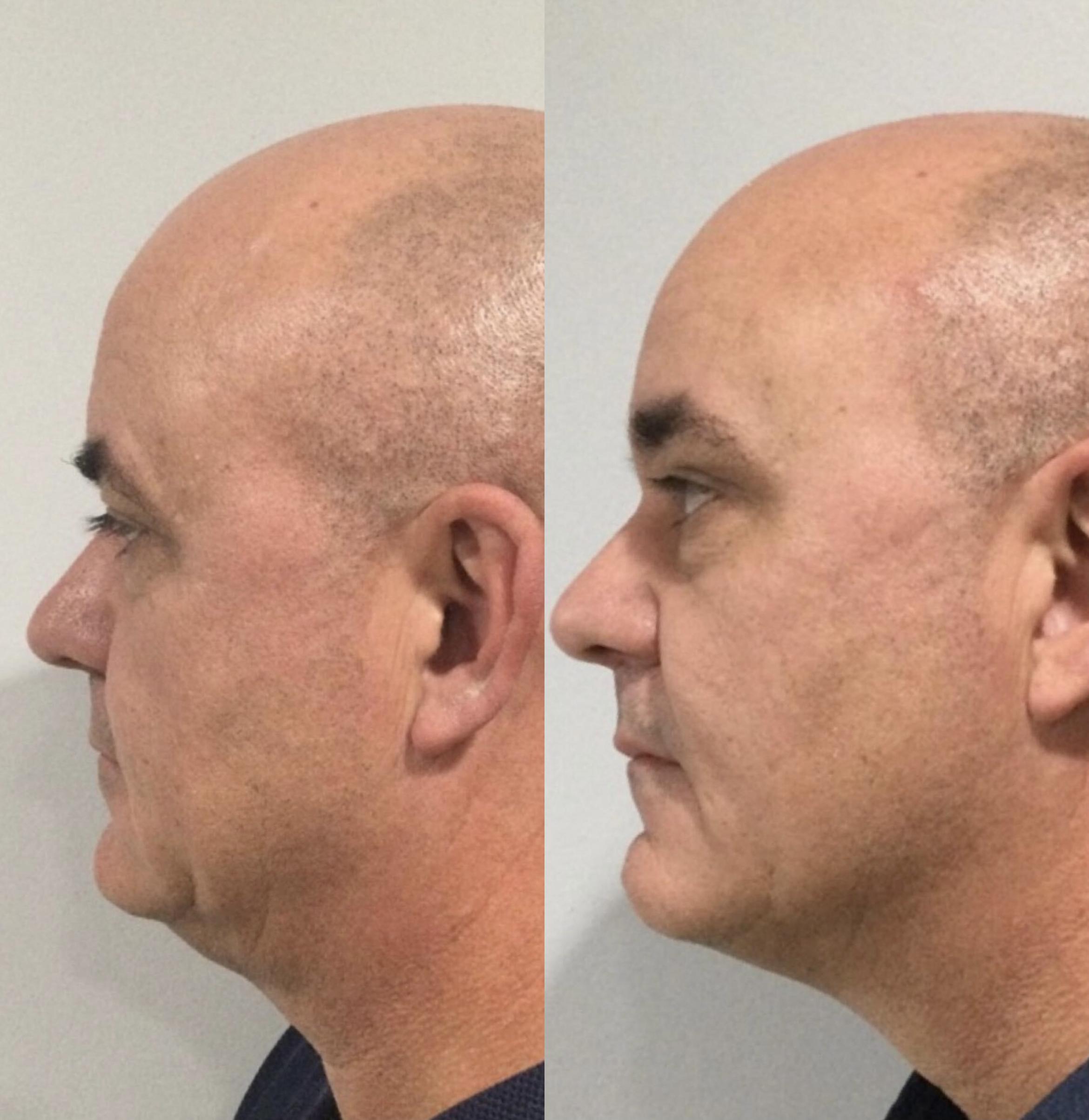 Before & After Kybella Case 66 Left Side View in Sacramento, CA