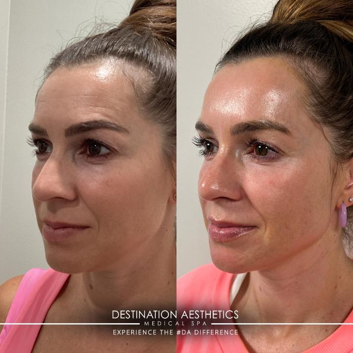 Before & After Laser Case 228 Left Side View in Sacramento, CA