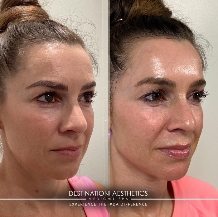 Before & After Laser Case 228 Right Side View in Sacramento, CA
