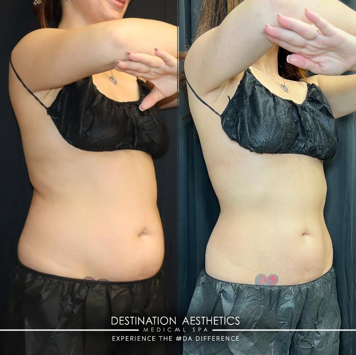 Before & After Medical Weight Loss Program Case 216 Left Side View in Sacramento, CA