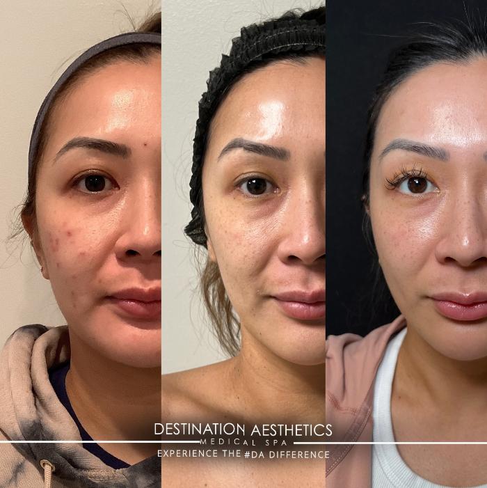 Before & After Laser Case 229 Front View in Sacramento, CA