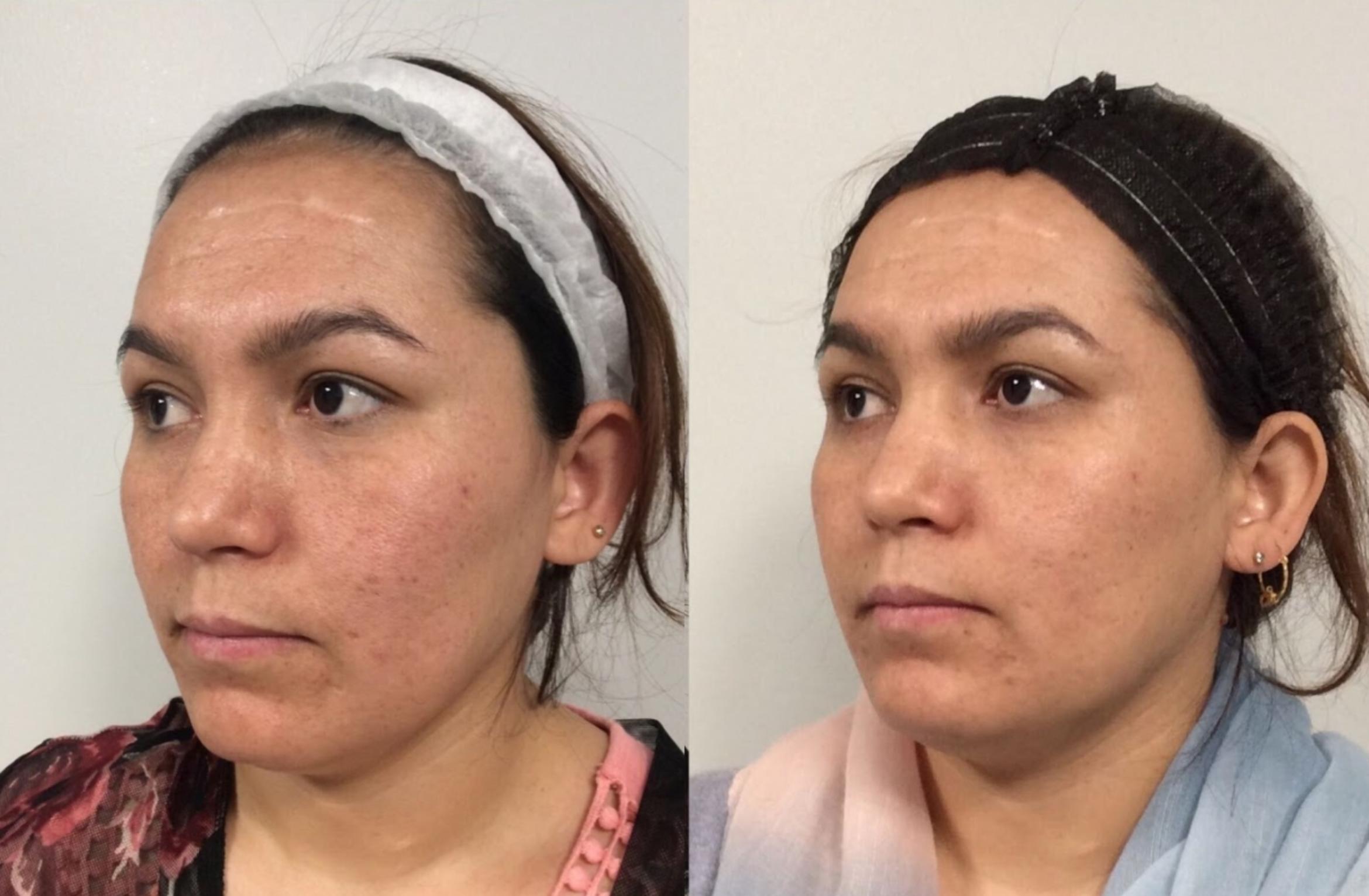 Before & After Microneedling Case 41 Front View in Sacramento, CA