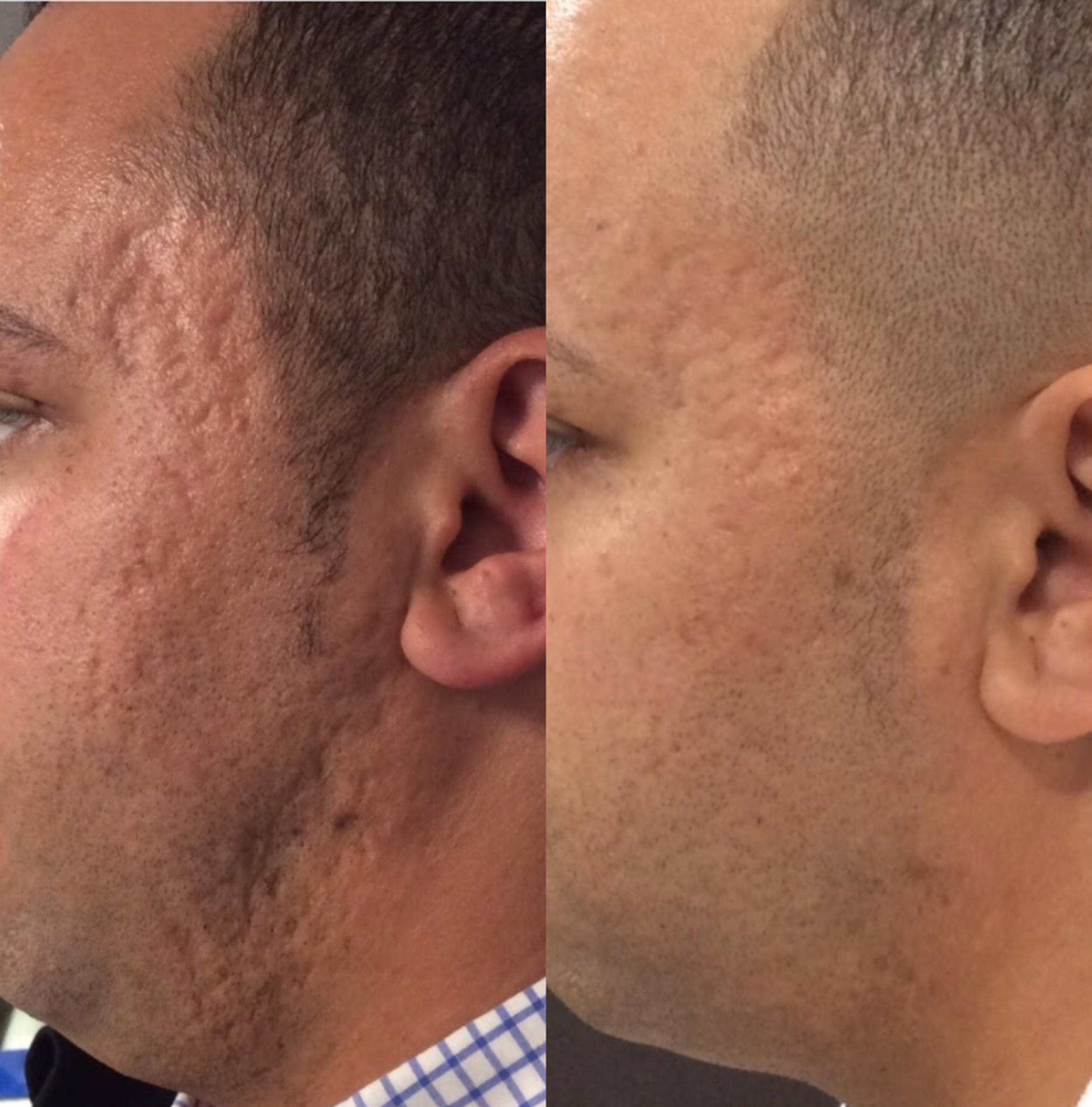 Before & After Microneedling Case 42 Left Side View in Sacramento, CA