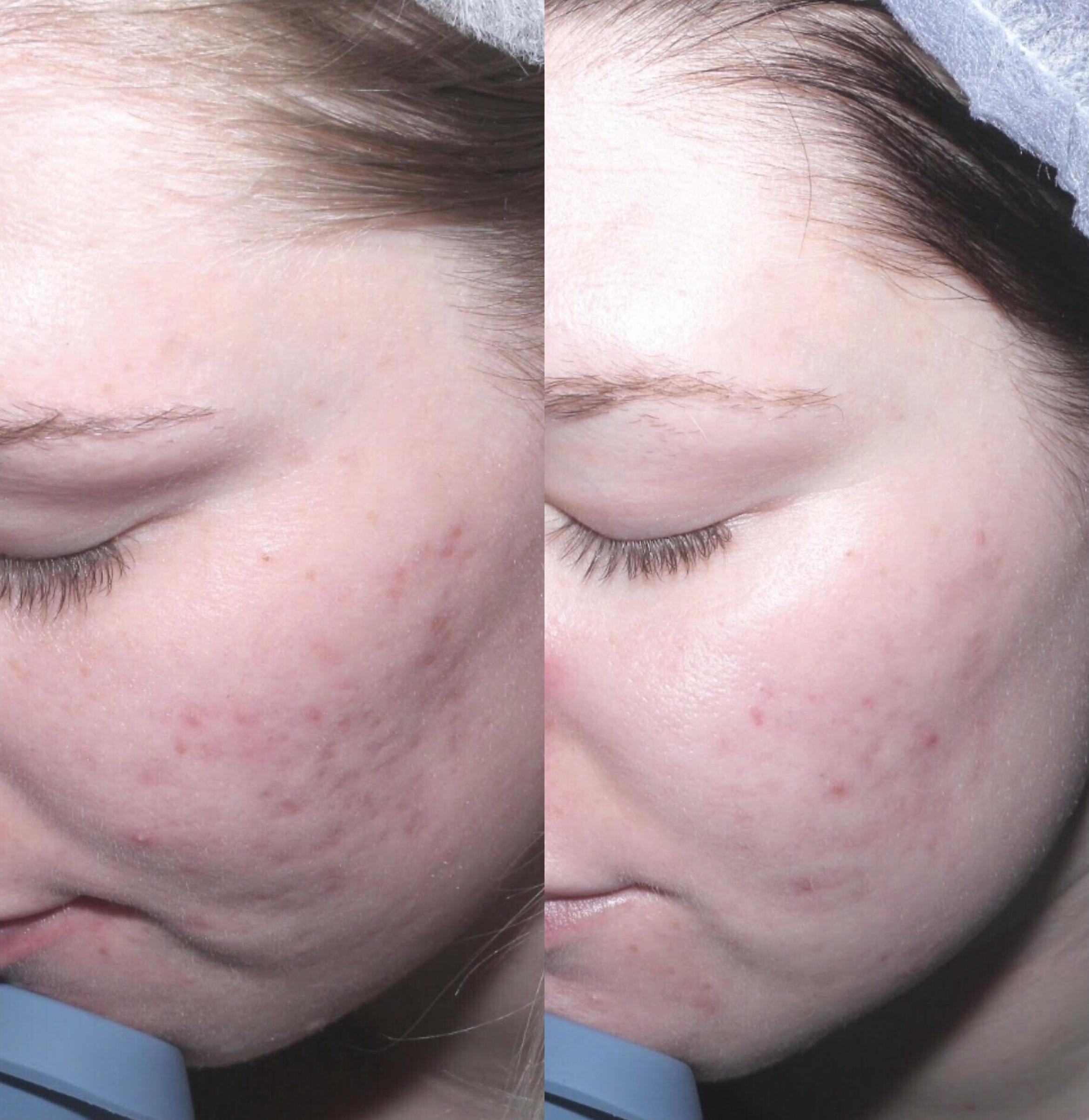 Before & After Microneedling Case 57 Left Side View in Sacramento, CA