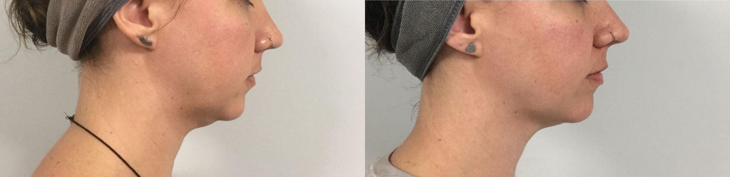 Before & After Ultherapy Case 19 Right Side View in Sacramento, CA